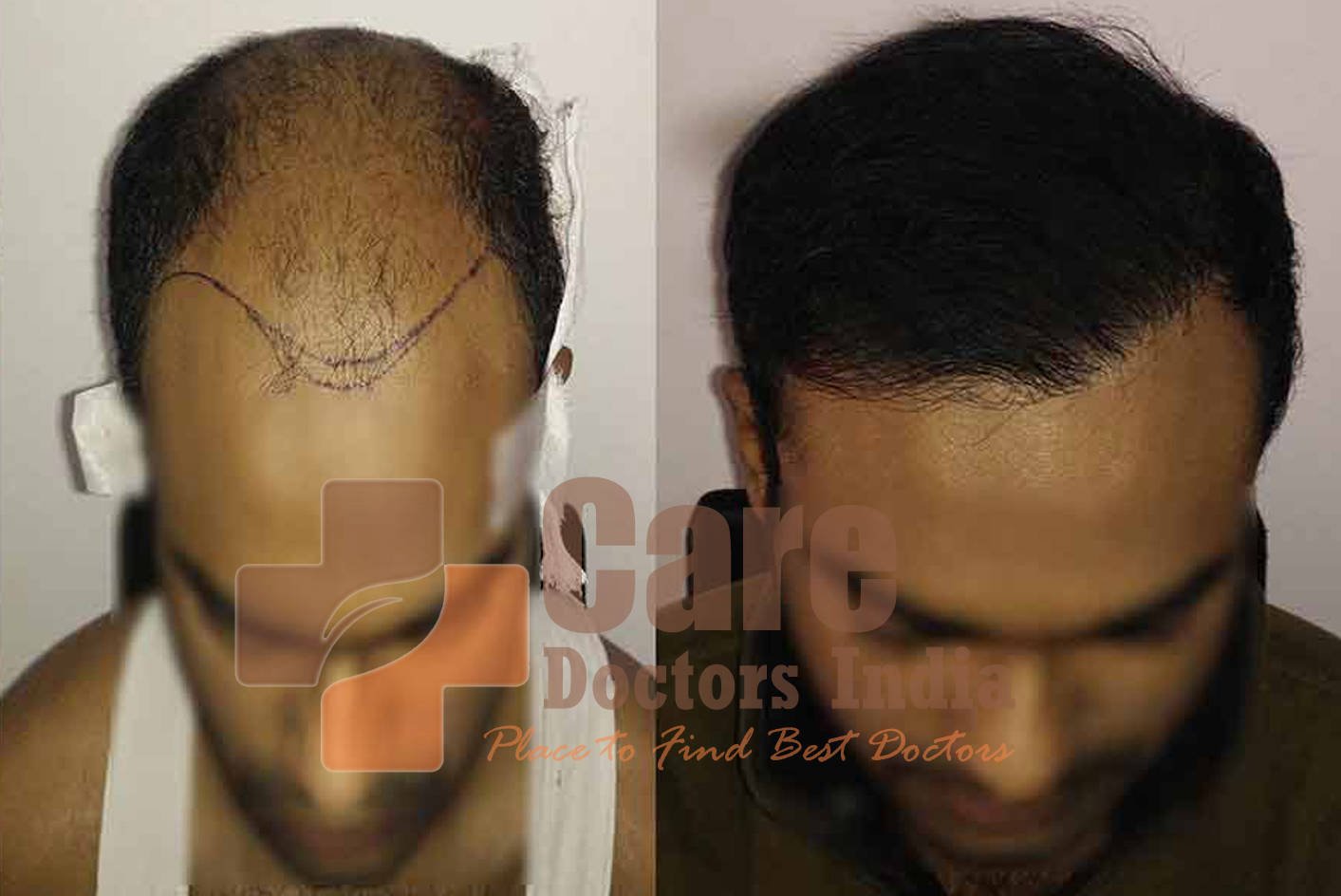 Best Advance Hair Transplant Results : CareDoctorsIndia