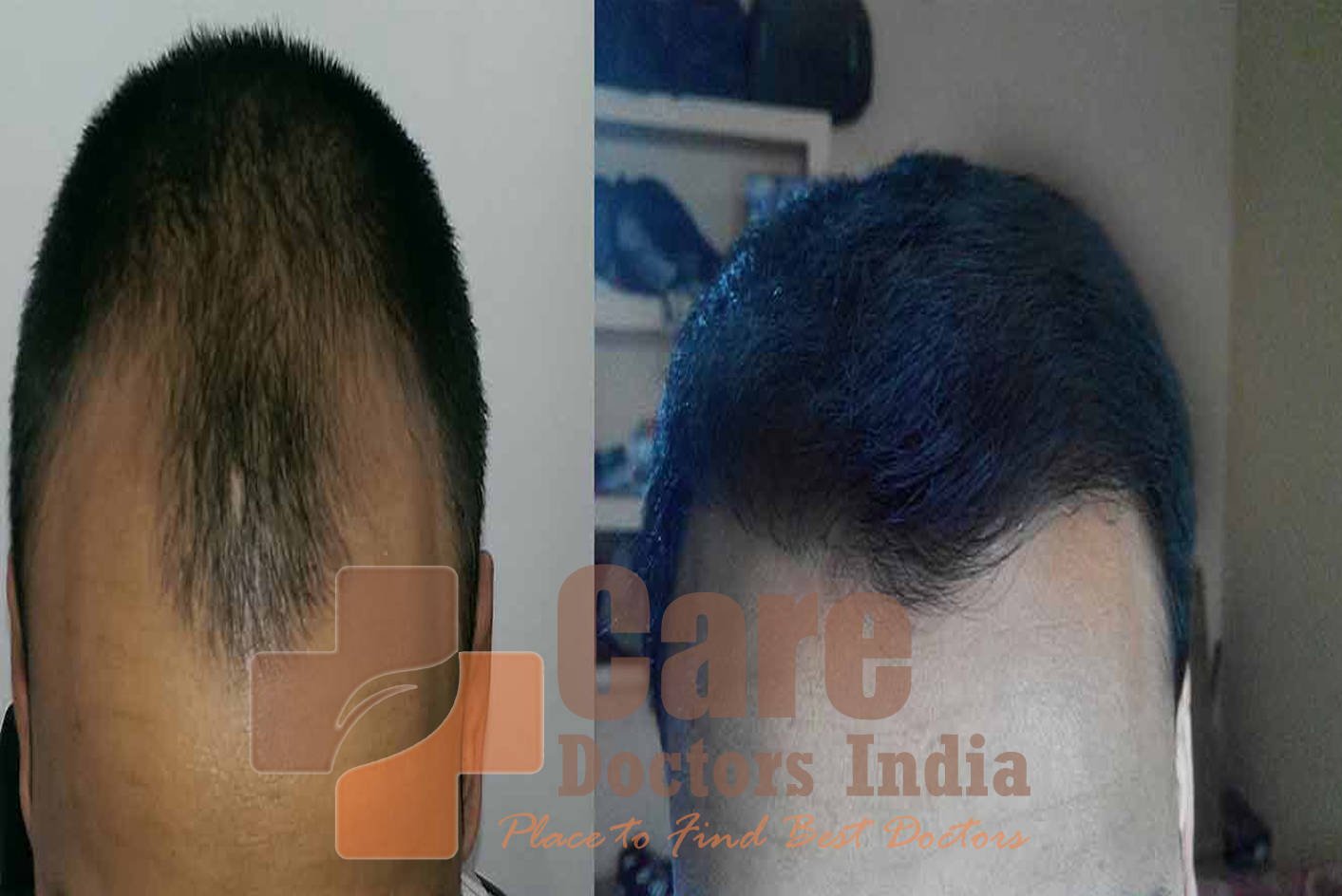 Best Advance Hair Transplant Results : CareDoctorsIndia