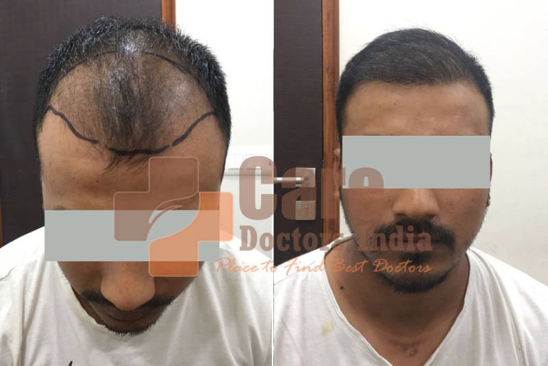 Best Advance Hair Transplant Results : CareDoctorsIndia