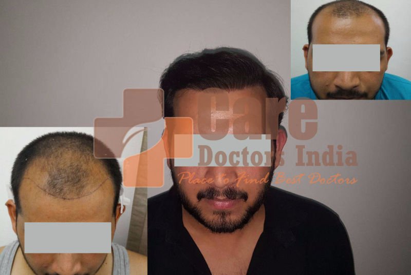 Best Advance Hair Transplant Results : CareDoctorsIndia