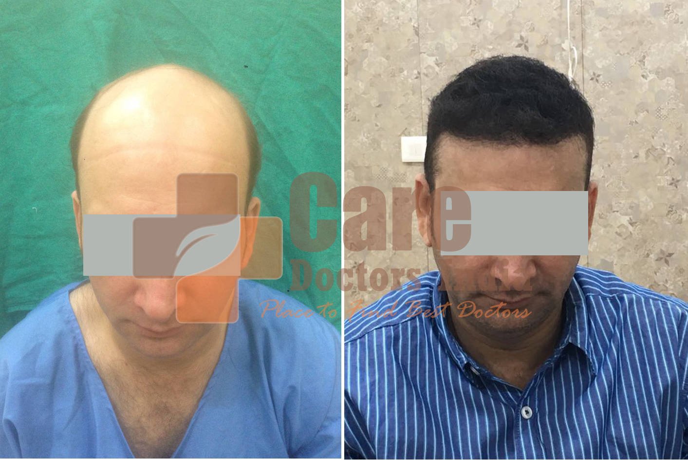 Best Advance Hair Transplant Results : CareDoctorsIndia