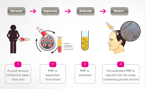 PRP therapy for Hair treatment