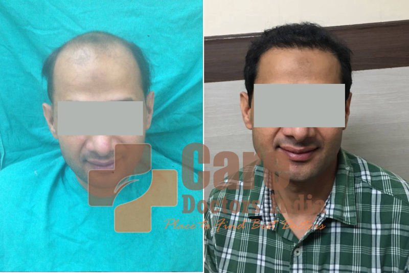 Best Advance Hair Transplant Results : CareDoctorsIndia