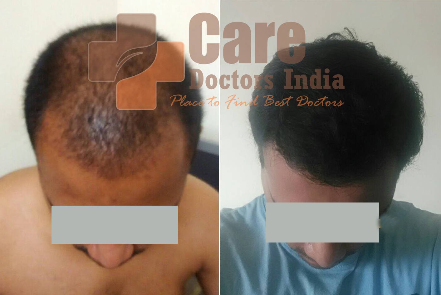 Best Advance Hair Transplant Results : CareDoctorsIndia