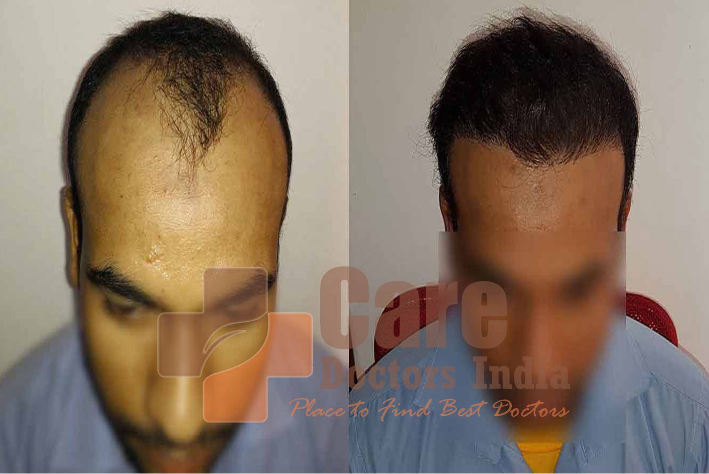 Best Advance Hair Transplant Results : CareDoctorsIndia